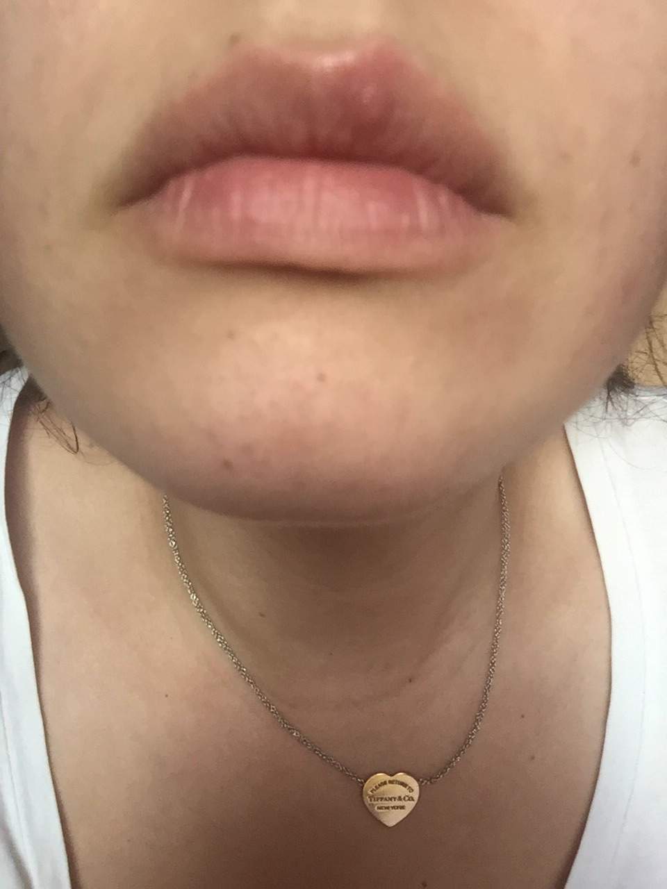 Ist das Herpes oder nicht? Lippe schwillt an aber es kommen keine bläschen
