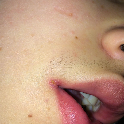 - (Krankheit, Erkältung, Herpes)