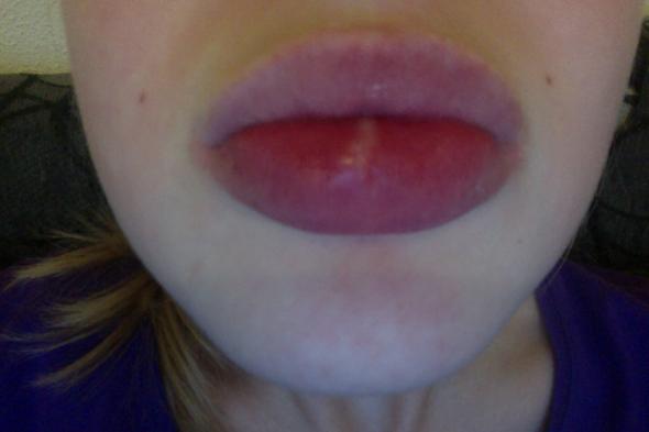 In der motte der lippe - (Lippe, Herpes)