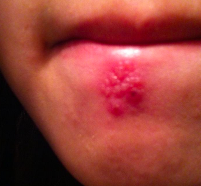 Get Pickel An Der Lippe Oder Herpes Images