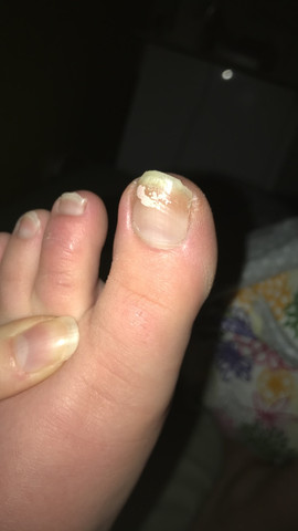 Ist das hier Nagelpilz? ( BILD )? (Gesundheit und Medizin, Angst, Pilze)