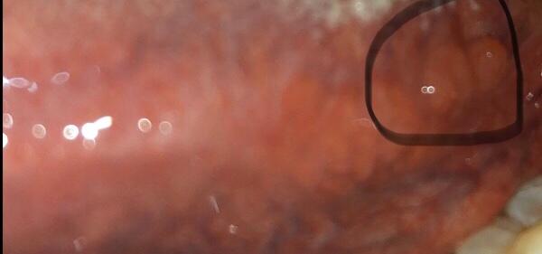 View Pickel Auf Der Zunge Seitlich Hinten Gif