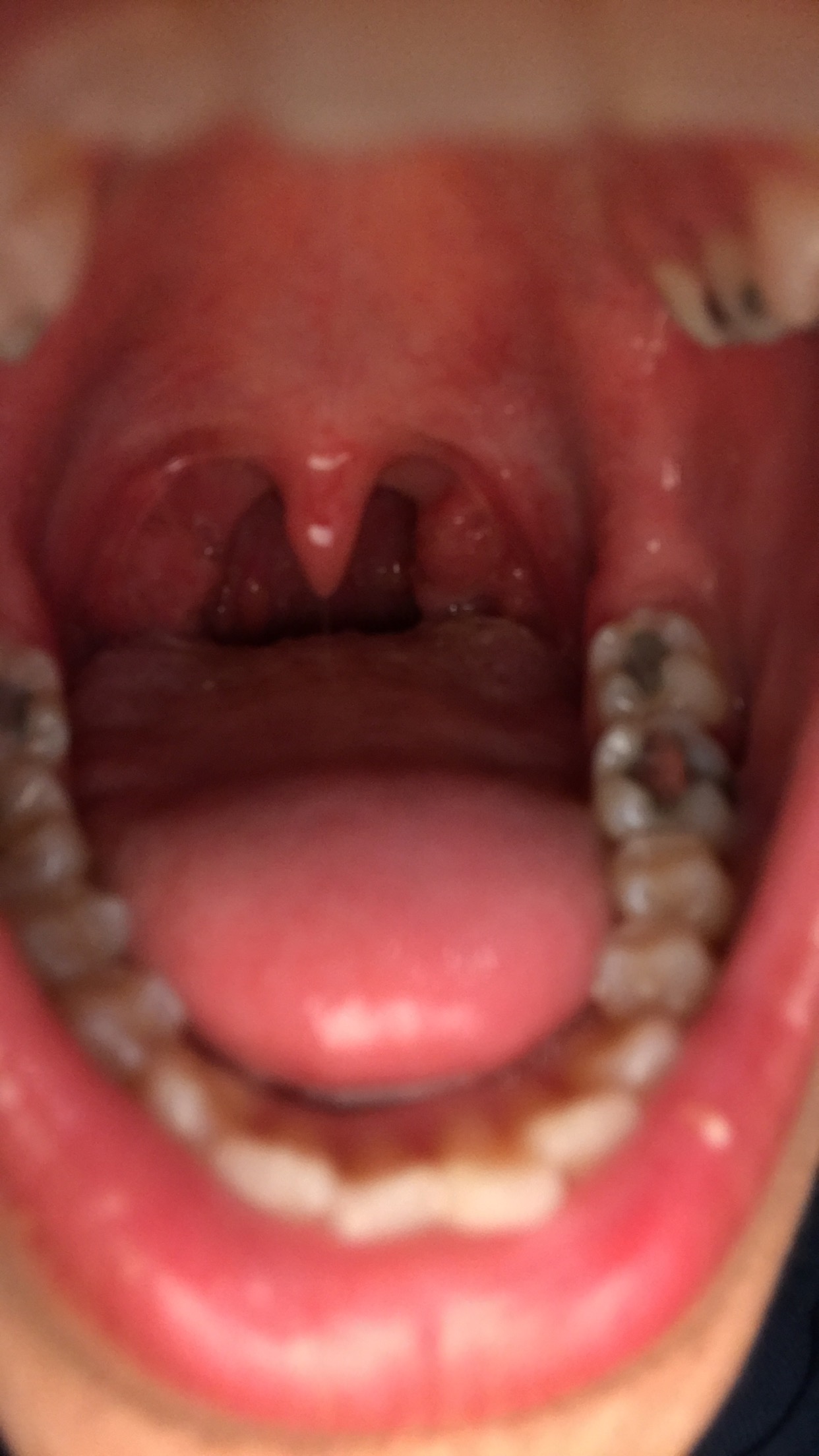 Ist das in meiner Mund Höhle normal habe das schon länger und habe ... Ist das in meiner Mund Höhle normal habe das schon länger und habe ...