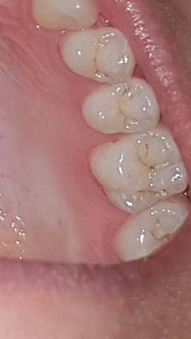 Ist Das Karies Zahne