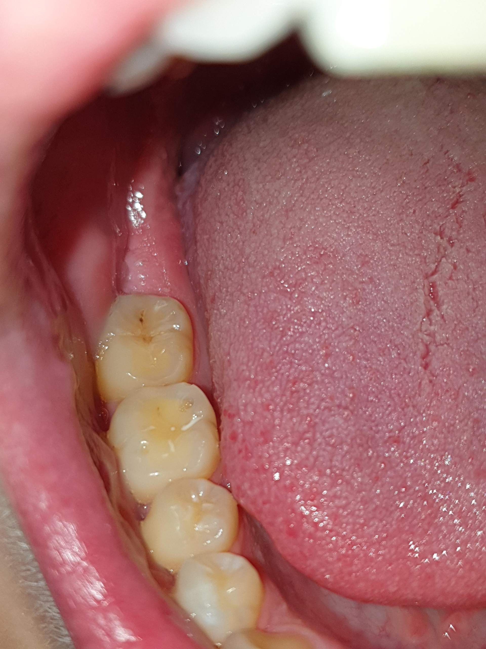 Ist das Karies? (Zahnarzt, verletzt)