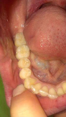 Zahn - (Zähne, Zahnarzt, Zahnschmerzen)
