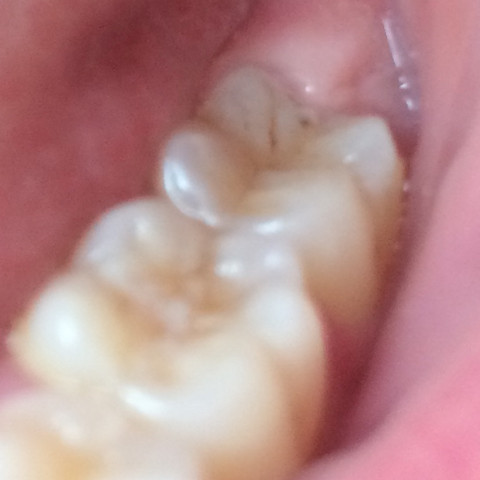 Zahn  - (Zähne, Zahnarzt, Karies)