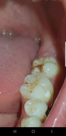 Ist Das Karies Hier Auf Meinem Zahn Gesundheit Und Medizin Zahne Zahnarzt Ist Das Karies Hier Auf Meinem Zahn Gesundheit Und Medizin Zahne Zahnarzt