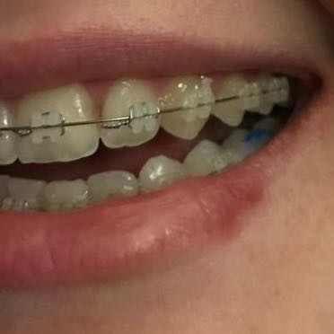 Zähne - (Gesundheit und Medizin, Zahnarzt, Zahnspange)