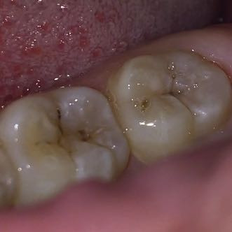 Ist Das Karies Und Kann Man Den Selbst Behandeln Angst Zahne Zahnmedizin