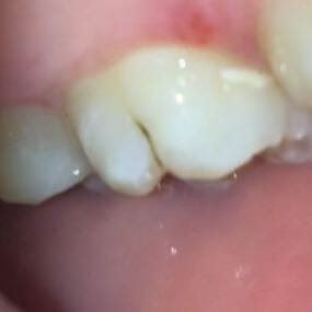 Ist Das Karies Und Kann Man Den Selbst Behandeln Angst Zahne Zahnmedizin