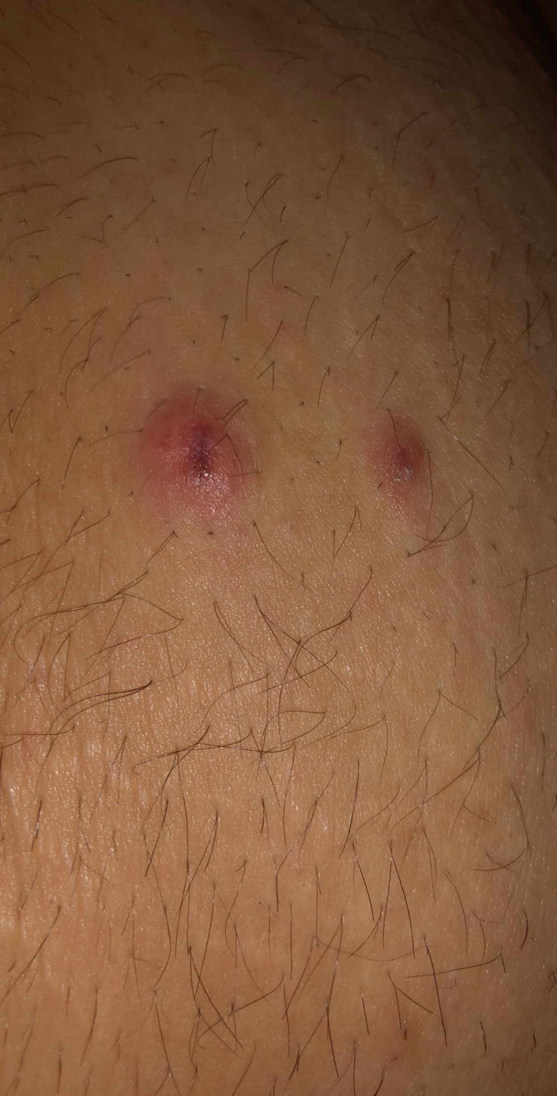 Ist das krätze? Hilfe? (Arzt, Dermatologie, Krätzemilben)
