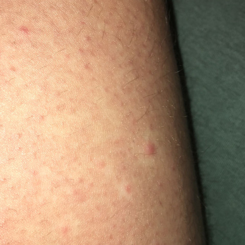 Ist Das Kratze Hatte Es Vor 3 Wochen Gesundheit Und Medizin Korper Apotheke Ist Das Kratze Hatte Es Vor 3 Wochen Gesundheit Und Medizin Korper Apotheke