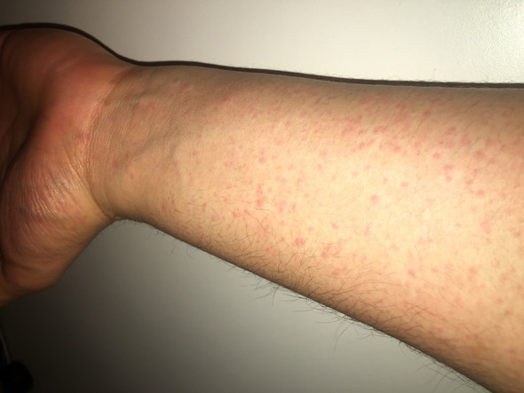 Ist Das Kratze Scabies Gesundheit Und Medizin Ausschlag Kratzemilben Ist Das Kratze Scabies Gesundheit Und Medizin Ausschlag Kratzemilben