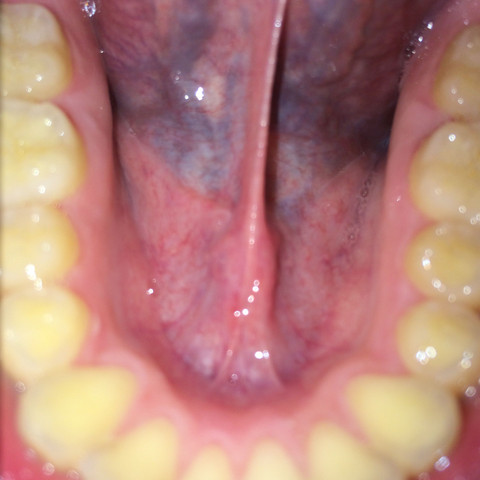 Mundboden - (Gesundheit und Medizin, Gesundheit, Krebs)