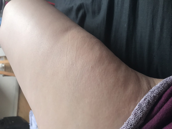 Ist Das Lipodem Oder Cellulite