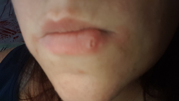 - (Gesundheit und Medizin, Lippe, Herpes)