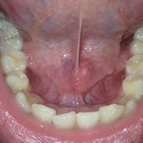 Rechts im Bild  - (Krebs, Zunge, Lymphknoten)