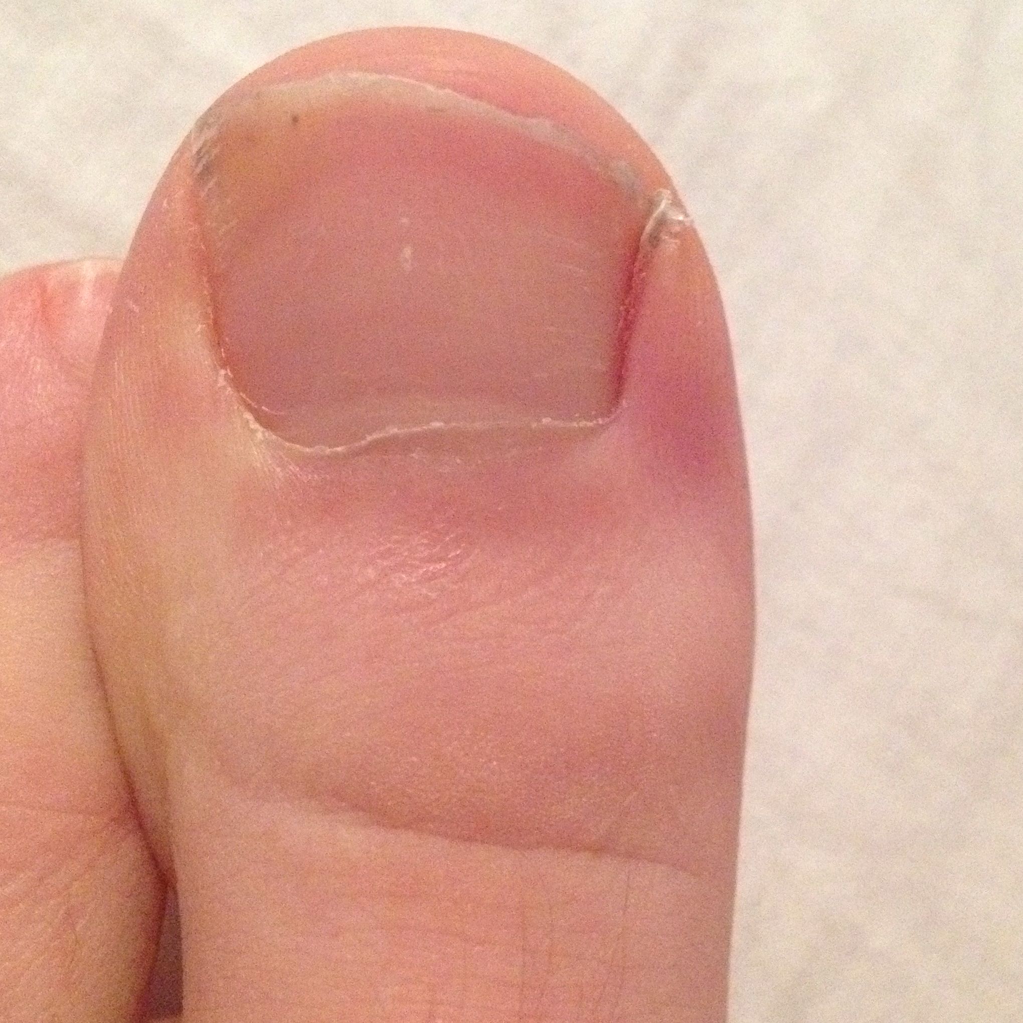 Ist das nagelpilz? (Hilfe) bitte (Foto) Ist das nagelpilz? (Hilfe) bitte (Foto)