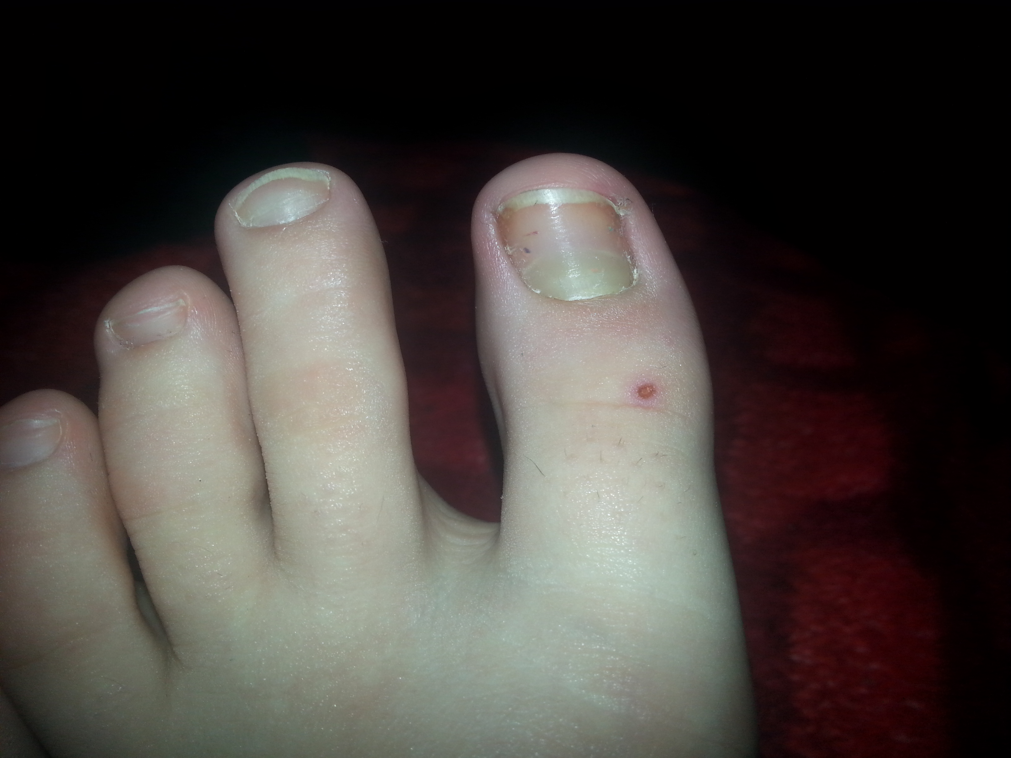 Ist das Nagelpilz? (Achtung bilder!) (Krankheit, Füße, Nägel) Ist das Nagelpilz? (Achtung bilder!) (Krankheit, Füße, Nägel)