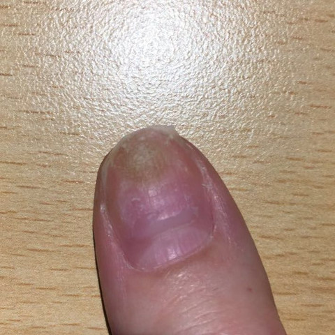 Nagelpilz  - (Gesundheit und Medizin, Mädchen, Gelnägel)