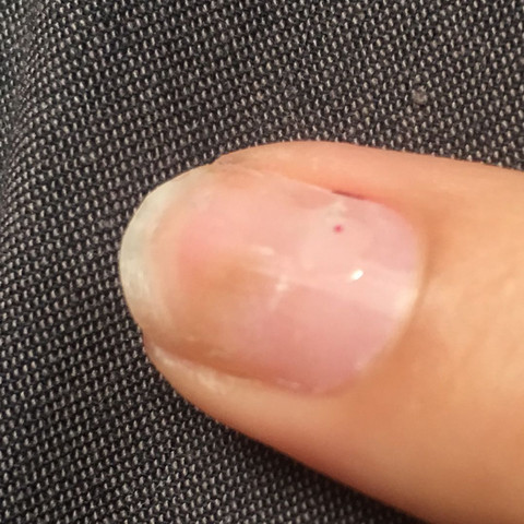 Mein Nägel sieht durch das abschleifen des Gels sehr kaputt aus, nicht beachten  - (Gesundheit und Medizin, Nagelpilz)