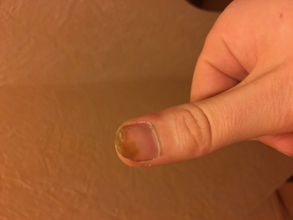 Mein rechter Fingernagel - (Medizin, Apotheke, Fingernägel)