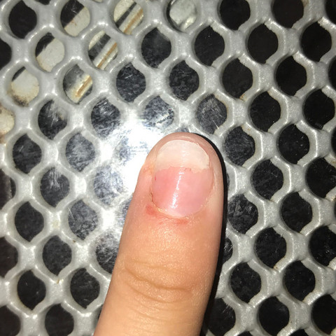 Zeigefinger - (Gesundheit und Medizin, Nägel, Psoriasis)