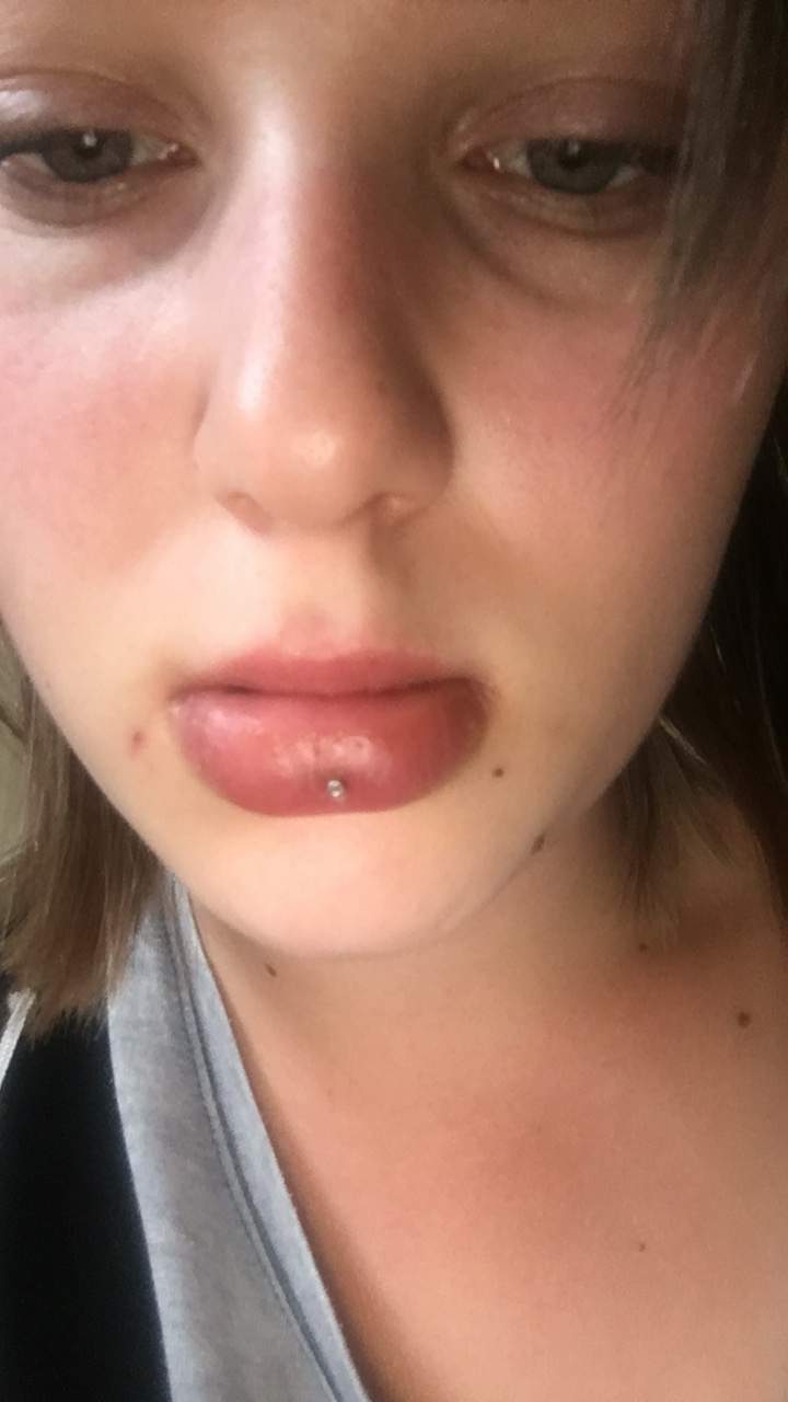ist das nich normal piercing schwellung