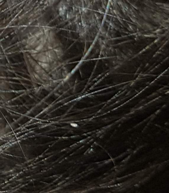 Ist das Nisse in mein Haar oder Nicht? (Haare, Läuse, Nissen)