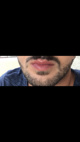 - (Gesundheit und Medizin, Herpesbläschen)