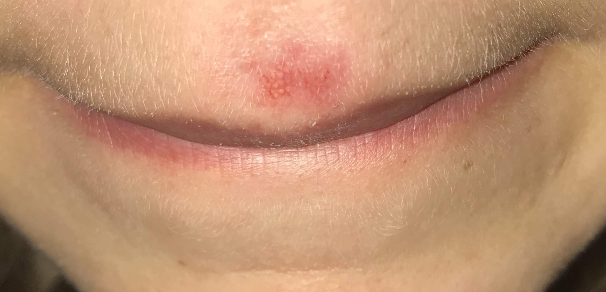 Ist das noch Herpes oder ist er schon verheilt? (Gesundheit, Symptome, Lippenherpes)