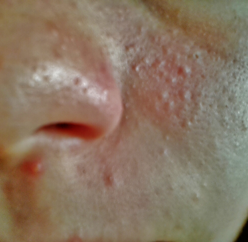 Ist das noch normaaaaal?! Pickel+Pubertät (Mädchen, Körper, Pflege) pickel in der pubertät