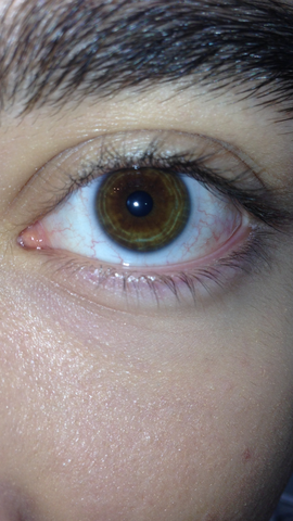 Ist Das Noch Normal Auge Iris Krankheit Augen Doktor Ist Das Noch Normal Auge Iris Krankheit Augen Doktor