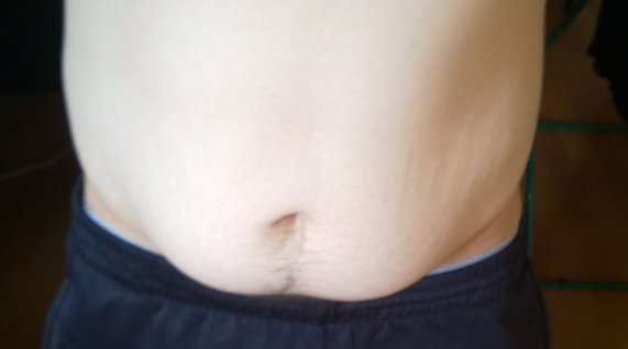 schlaffe haut was tun