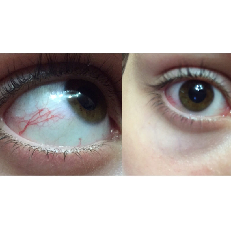 Ist das normal? Auge rot (Augen, müde, Adern)