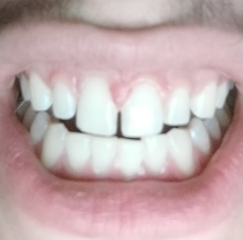 - (Gesundheit und Medizin, Zähne, Dick)
