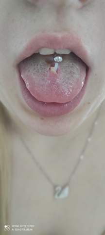 Ist das "normal" beim frischen Zungenpiercing?