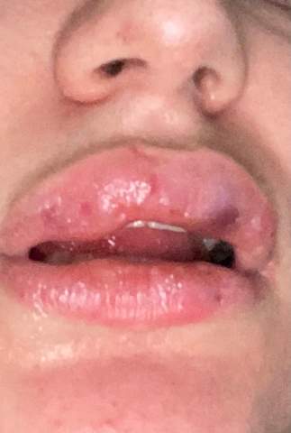 Ist das normal beim lippen aufspritzen das es so wird?