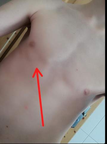 Ist Das Normal Das Bei Meiner Linken Brust Ein Kleines Stuck Fehlt Bin 14 Gesundheit Und Medizin Ist Das Normal Das Bei Meiner Linken Brust Ein Kleines Stuck Fehlt Bin 14 Gesundheit Und Medizin