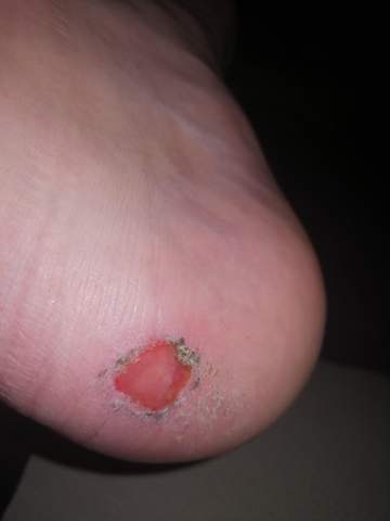 Ist Das Normal Das Eine Blase Am Fuss So Aussieht Gesundheit Und Medizin Ist Das Normal Das Eine Blase Am Fuss So Aussieht Gesundheit Und Medizin
