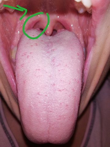 Ist Das Normal Dass Der Rachen Leicht Gerotet Ist Korper Krankheit Hals Ist Das Normal Dass Der Rachen Leicht Gerotet Ist Korper Krankheit Hals