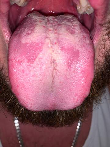 Get Pickel Im Mund Rachen PNG