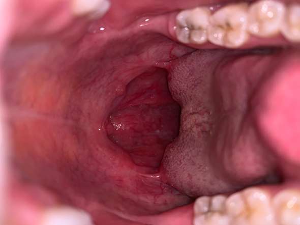 Ist Das Normal Im Rachen Gesundheit Und Medizin Ist Das Normal Im Rachen Gesundheit Und Medizin