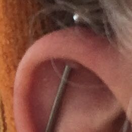 Hier erkennt man das mein Ohr allgemein etwas dicker ist. - (Gesundheit und Medizin, Piercing, Entzündung)