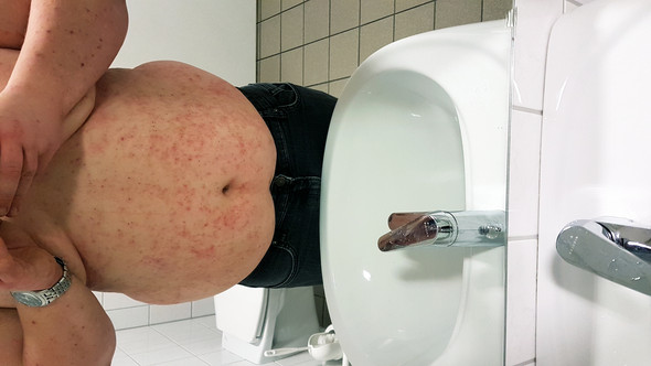 Ist Das Normal Nach Der Behandlung Gesundheit Und Medizin Kratze Kratzemilben Ist Das Normal Nach Der Behandlung Gesundheit Und Medizin Kratze Kratzemilben