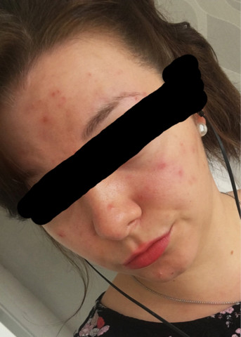 Ist Das Rosazea Bild Falls Ja Was Kann Ich Machen Haut Pickel Akne