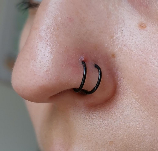 Gel piercing wildfleisch tyrosur Behandlung von