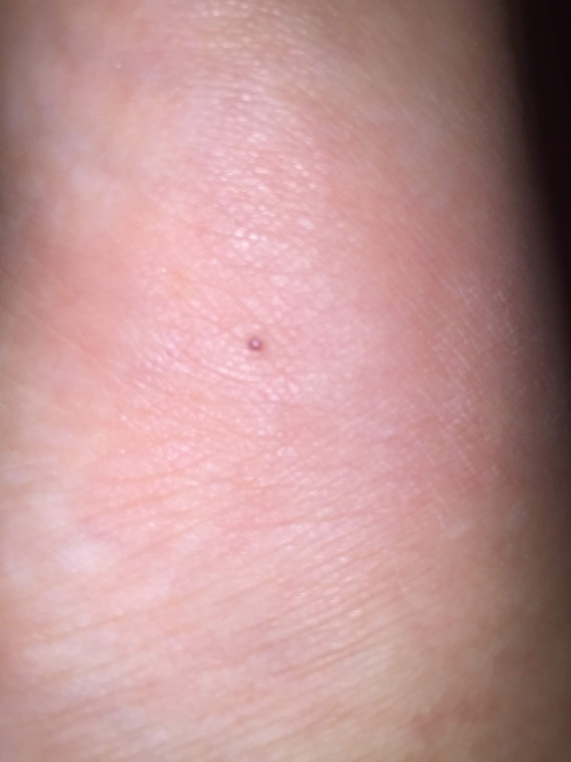 Ist das ein Zeckenbiss? (Gesundheit, Arzt,