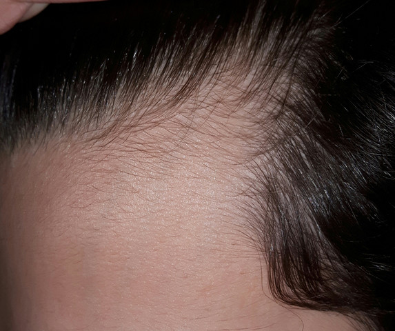 Ist Das So Normal Oder Ausfall Gesundheit Haare Haarausfall